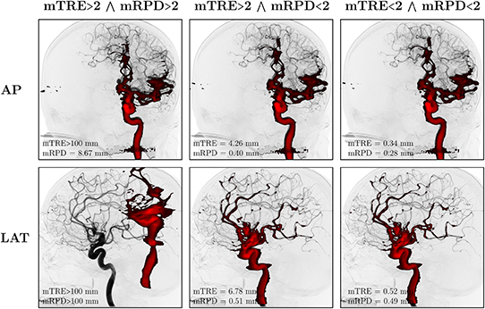 3D–2D registration of vascular structures - Book chapter - IOPscience