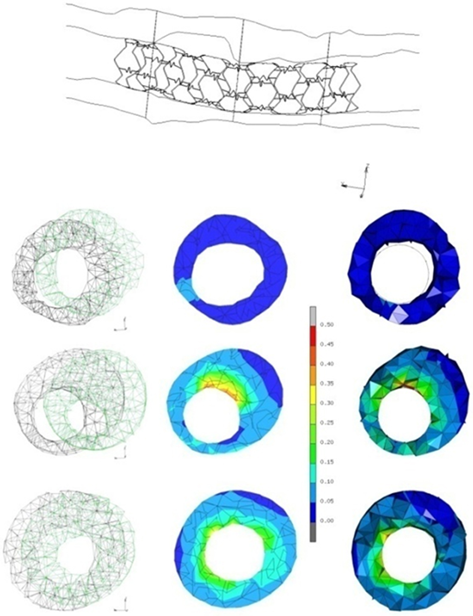Blood Flow Simulated Computer modeling of blood flow and plaque progression in the stented ...