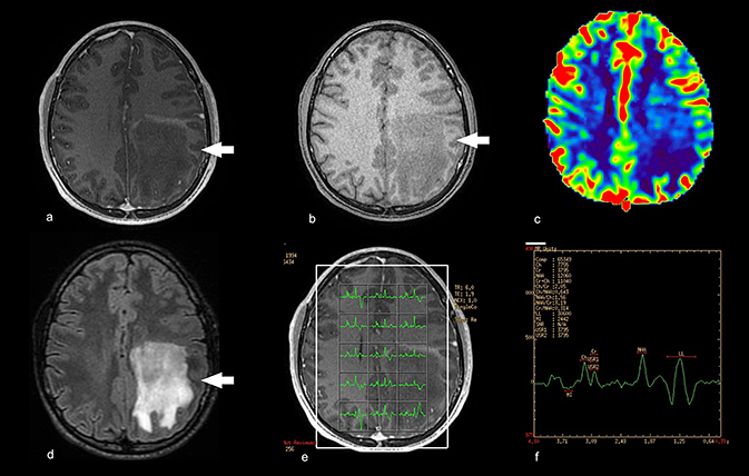 MRI spectroscopy in neurological disorders - Book chapter - IOPscience
