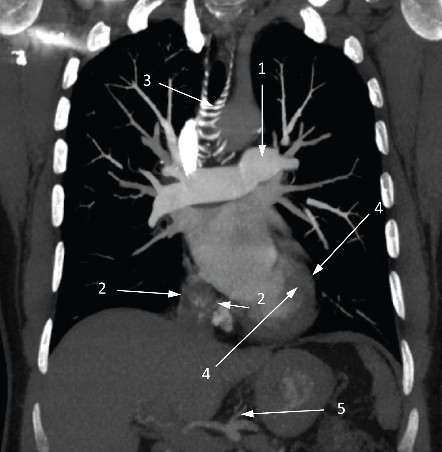 健康・医学 the thorax Muller's Imaging of the Chest: Expert Radiology Series