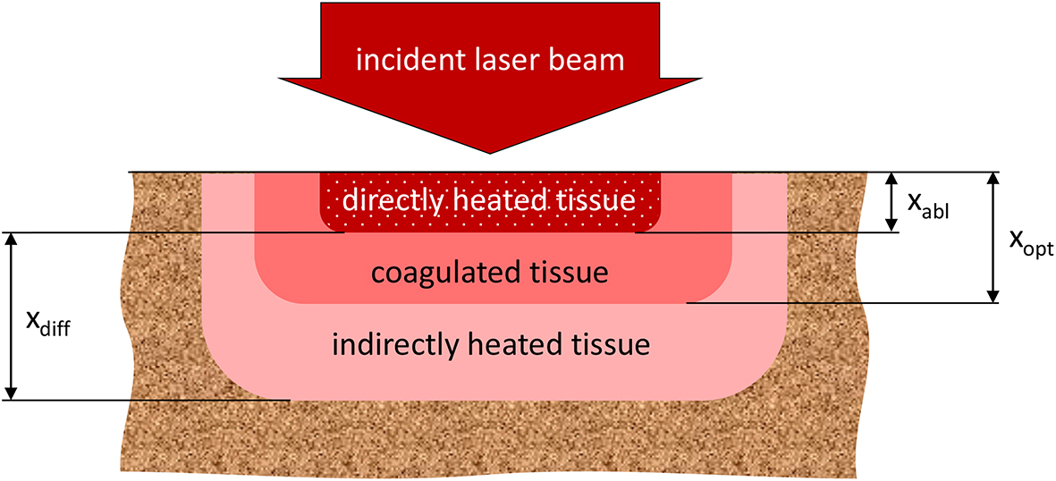 Tissue Optik Tissue optics and laser–tissue interactions - Book chapter - IOPscience