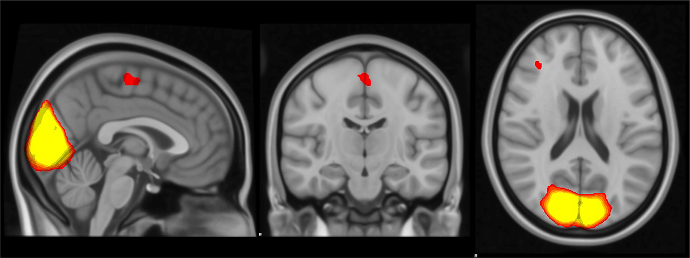 Computational analysis techniques: a case study on fMRI for autism ...