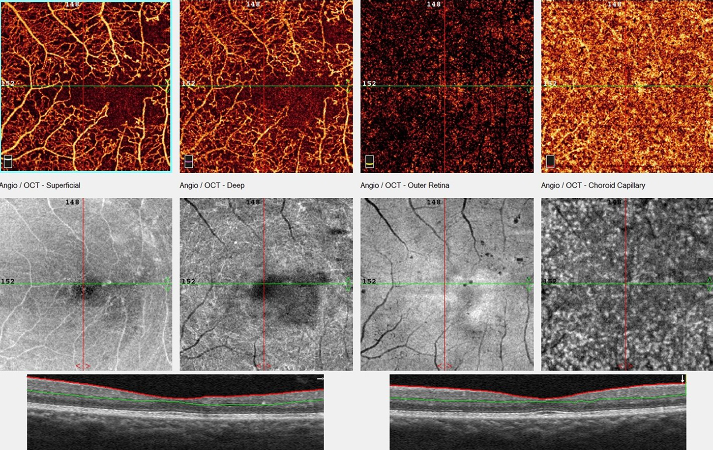 Retinal Scan With Rvo Clinical application of optical coherence tomography angiography in ...