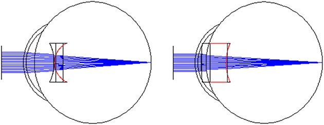 Mechanically adjustable lenses - Book chapter - IOPscience