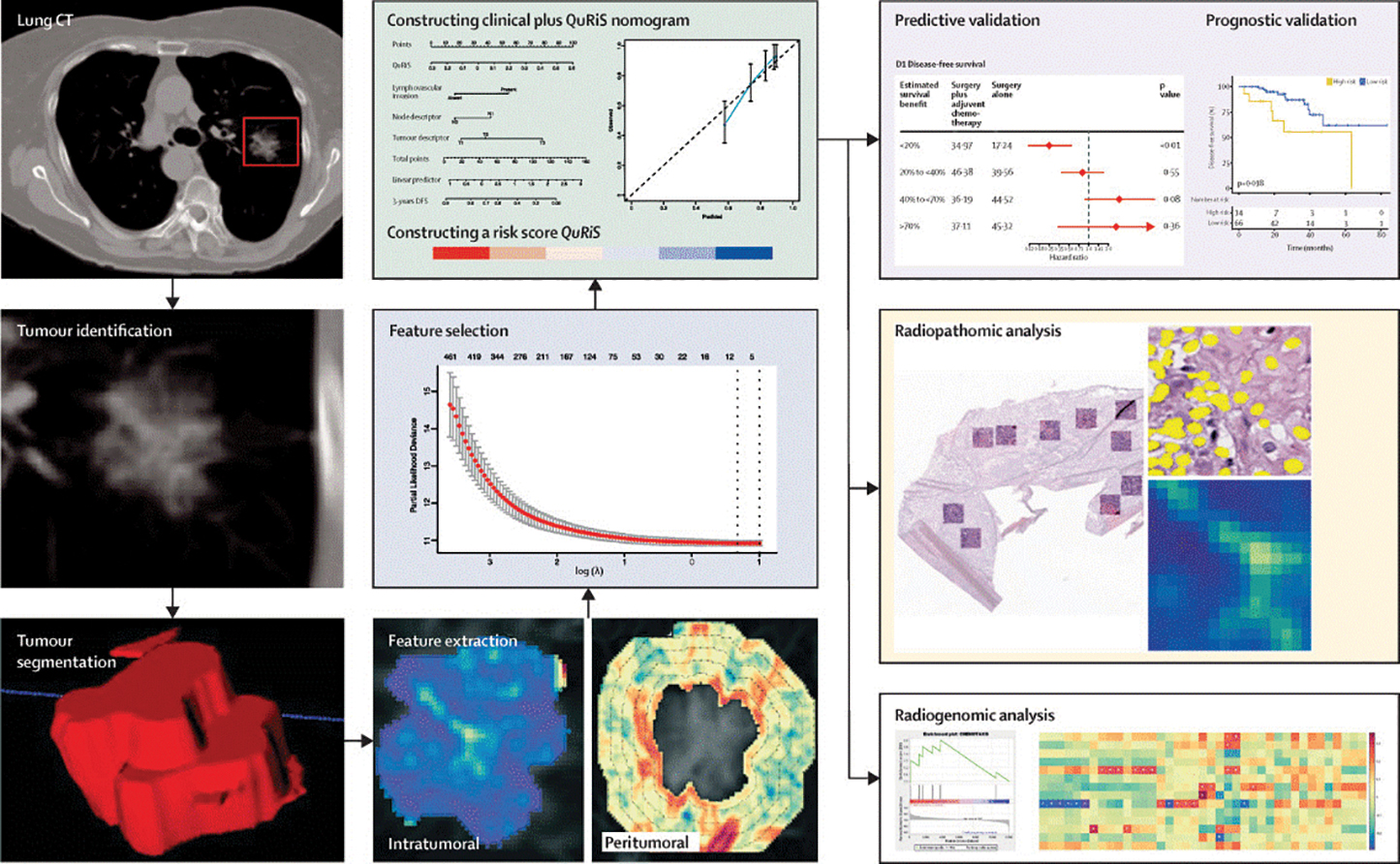 Challenges in artificial intelligence development of radiotherapy ...