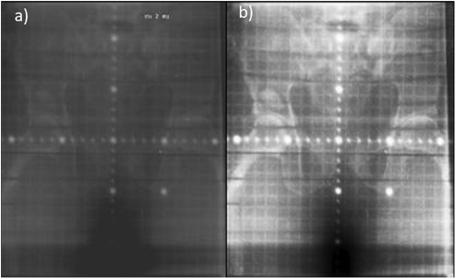 Offset In Radiography Two-dimensional (2D) off-line image guidance in radiation therapy ...