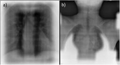 Two-dimensional (2D) off-line image guidance in radiation therapy ...