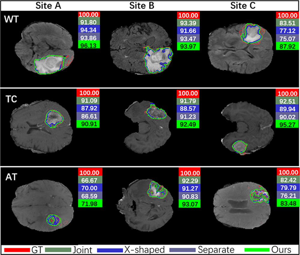 Multisite brain tumor segmentation using a unified generative ...