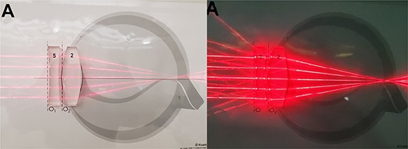 Eye Tensor Human eye and corrective lenses - Book chapter - IOPscience