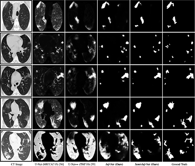 Inf-Net: an automatic lung infection segmentation network that uses CT ...