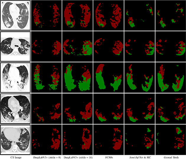 Inf-Net: an automatic lung infection segmentation network that uses CT ...