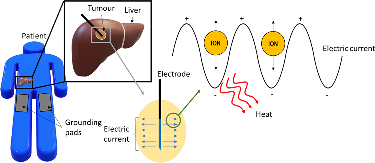 Heat transfer in biological tissues - Book chapter - IOPscience