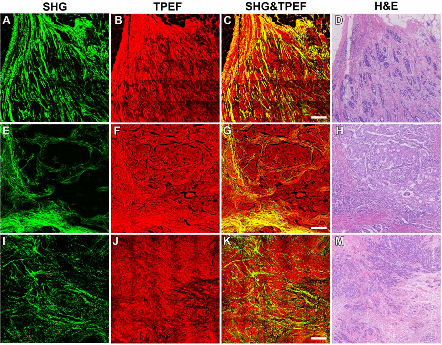 Automated classification of breast cancer histologic grade using ...