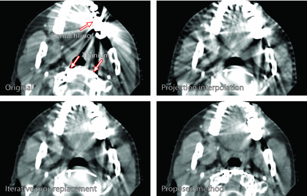CT metal artifact reduction method correcting for beam hardening and ...