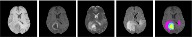A survey of MRI-based medical image analysis for brain tumor studies ...