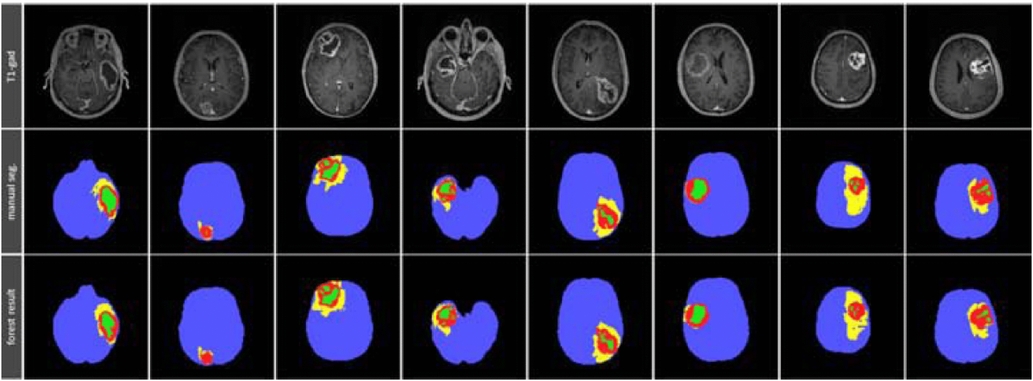 A survey of MRI-based medical image analysis for brain tumor studies ...