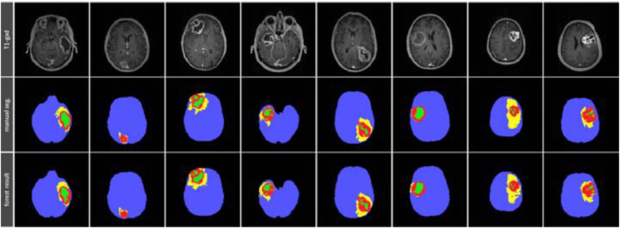 A survey of MRI-based medical image analysis for brain tumor studies ...