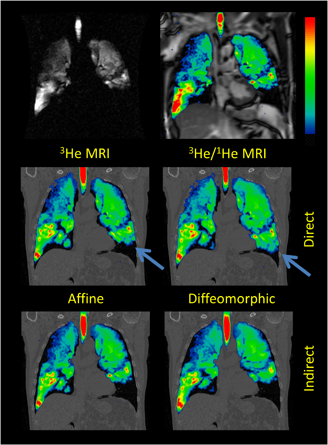 A method for quantitative analysis of regional lung ventilation using ...