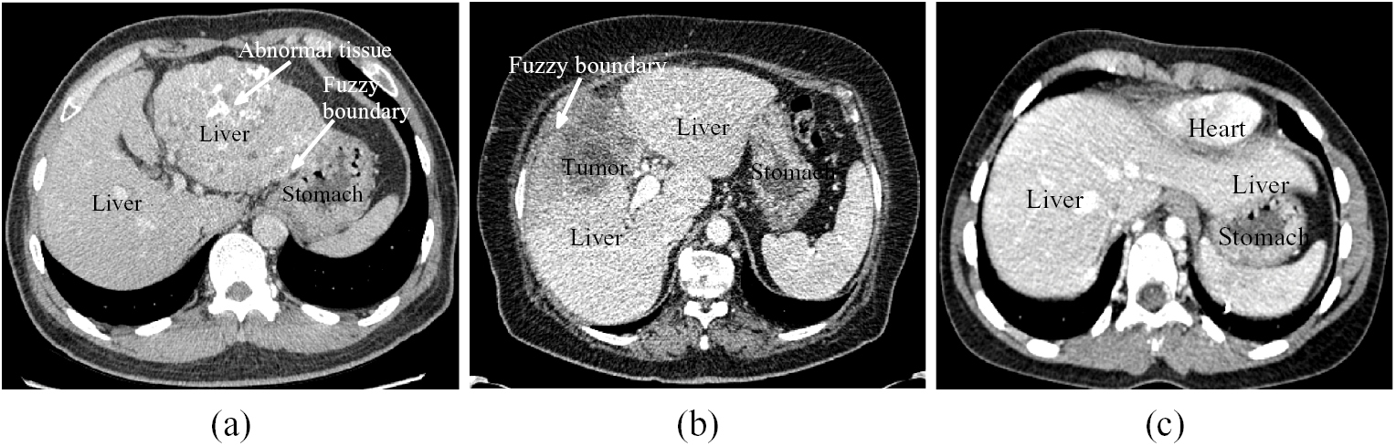 Automatic 3D liver segmentation based on deep learning and globally ...