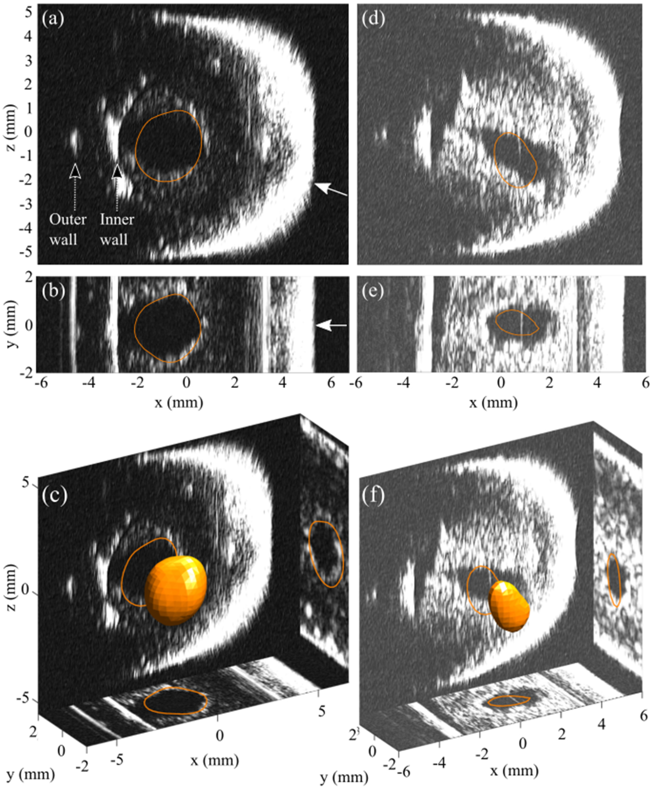 Megahertz rate, volumetric imaging of bubble clouds in sonothrombolysis ...