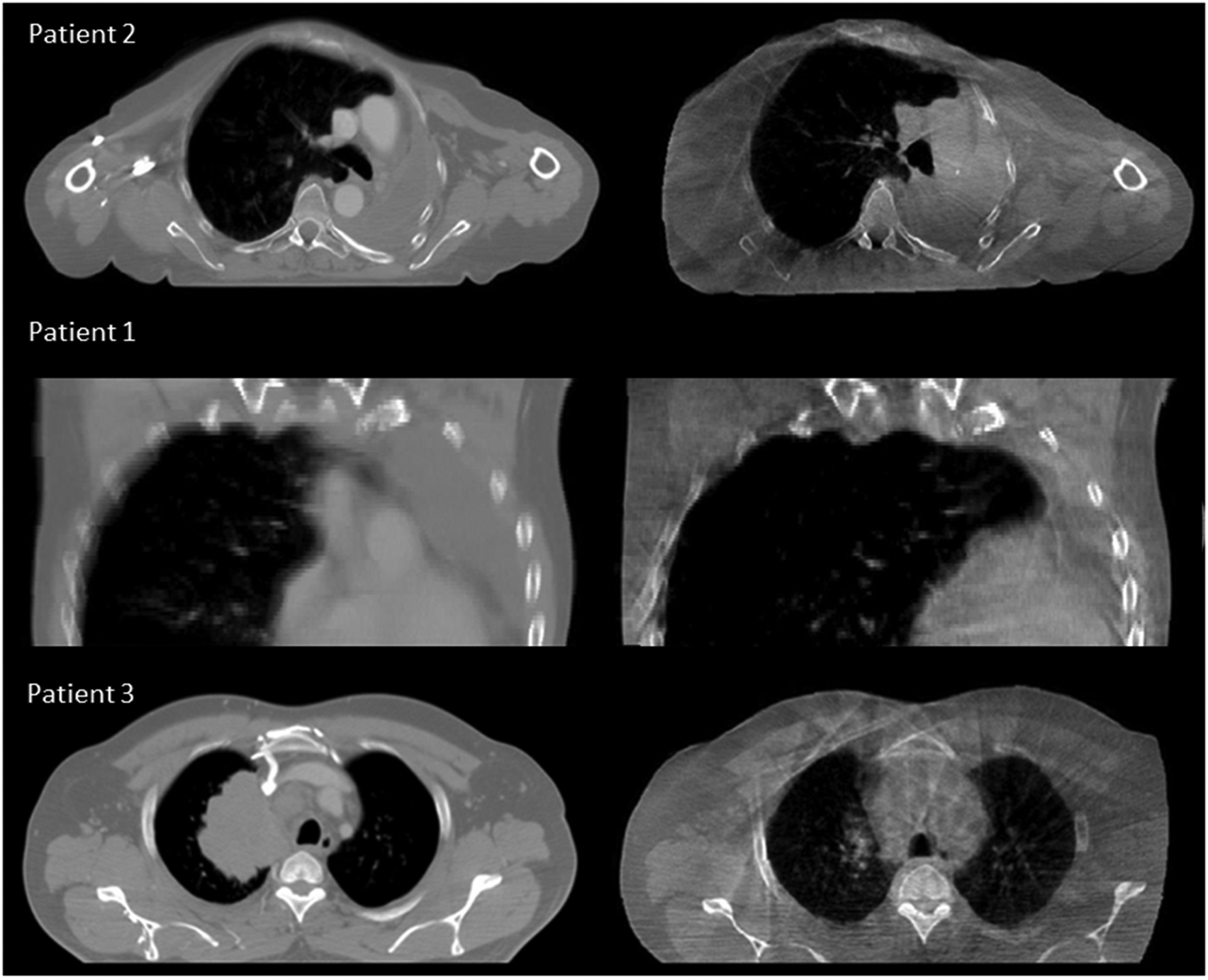 Ccot Radiographic Toward adaptive radiotherapy for lung patients: feasibility study on ...