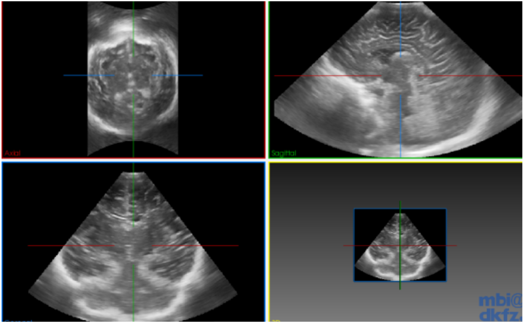 Computer-aided lateral ventricular and brain volume measurements in 3D ...