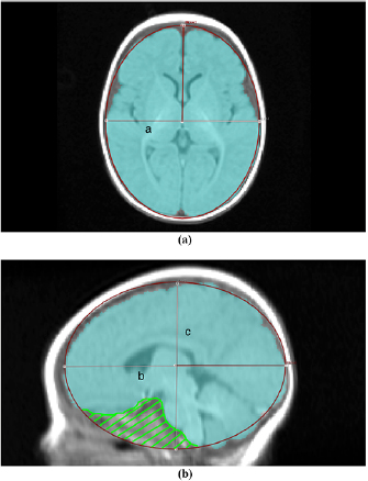 Computer-aided lateral ventricular and brain volume measurements in 3D ...