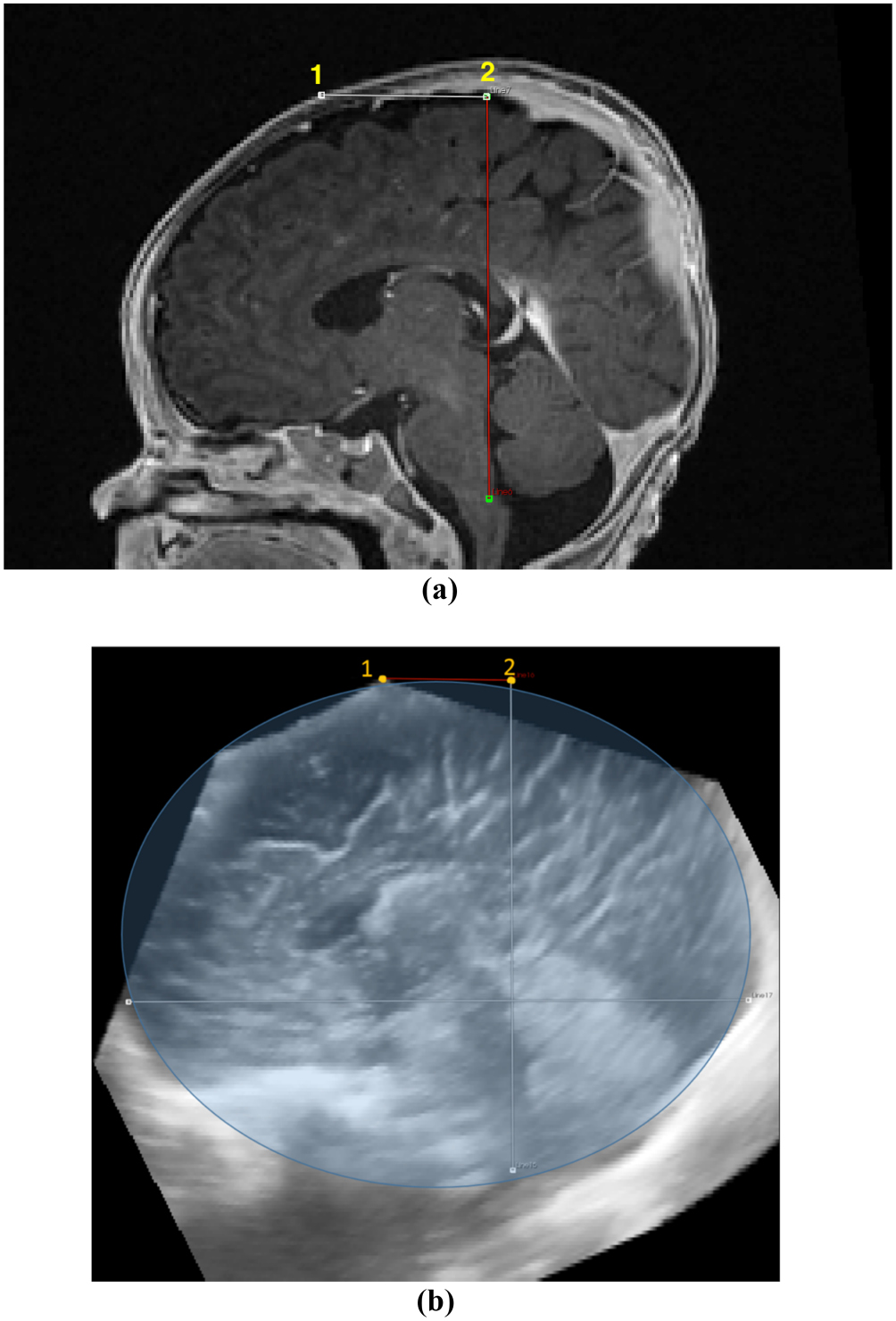 Computer-aided lateral ventricular and brain volume measurements in 3D ...