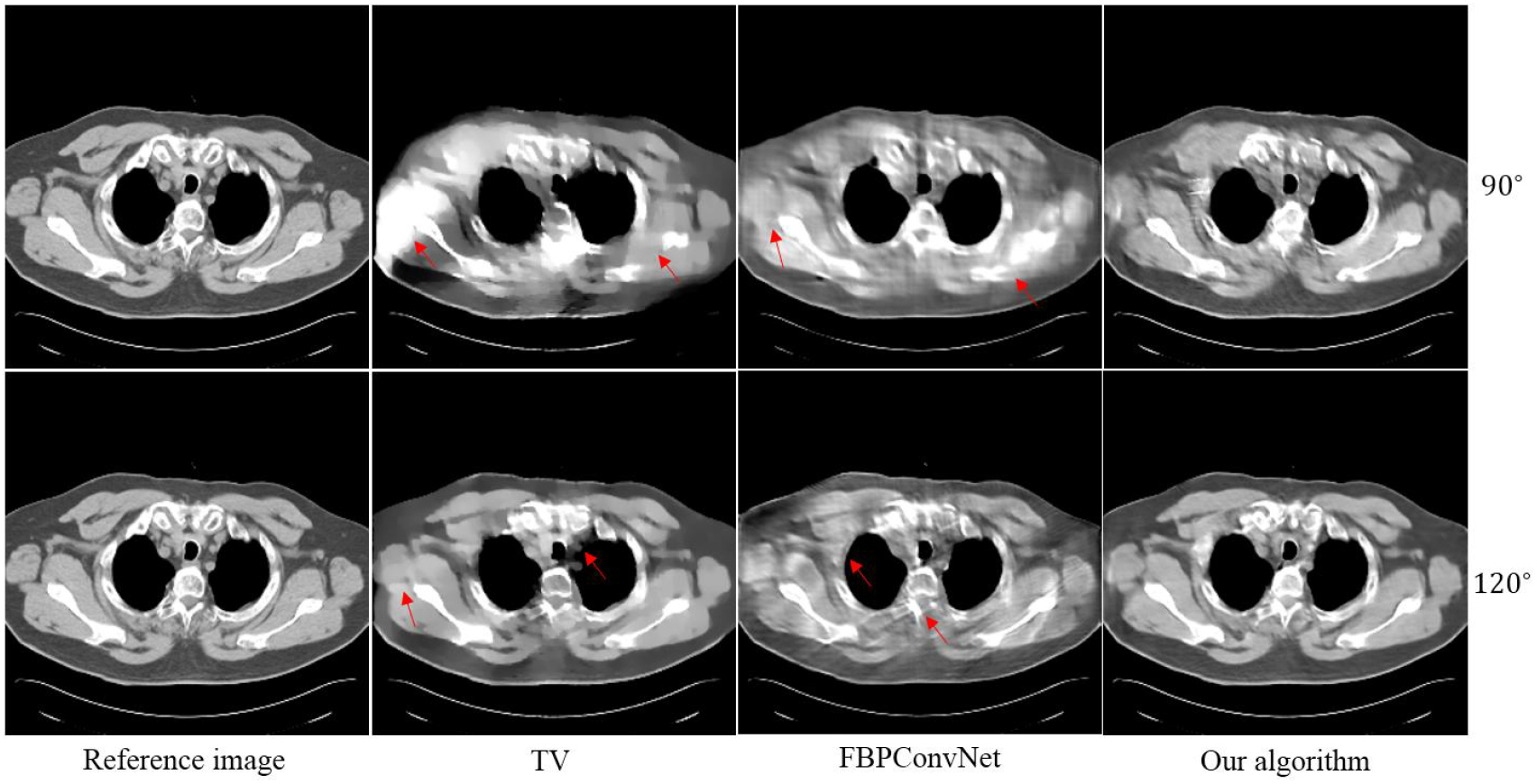 Mmd Algorithm Ct ADMM-based deep reconstruction for limited-angle CT - IOPscience