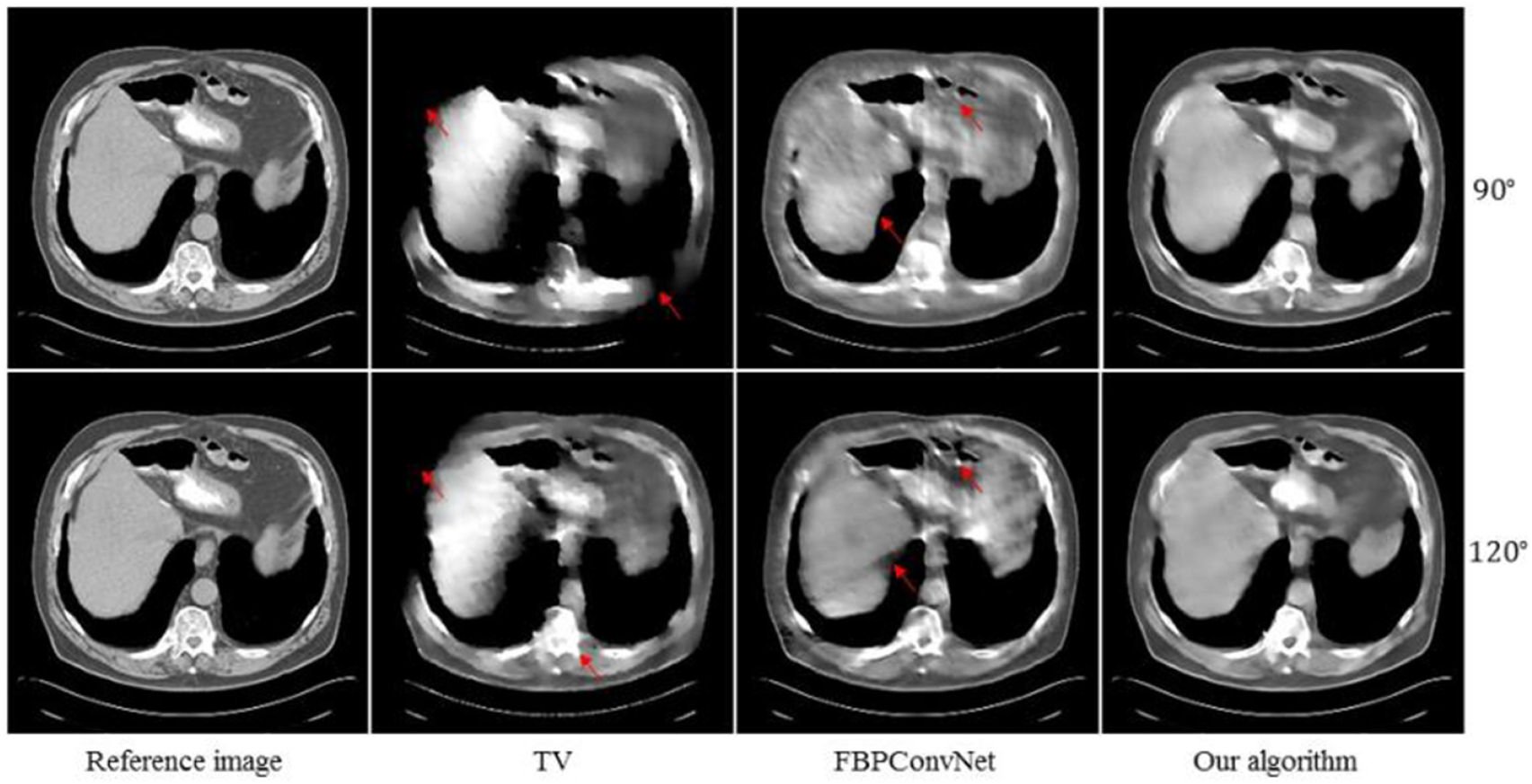 Mmd Algorithm Ct ADMM-based deep reconstruction for limited-angle CT - IOPscience
