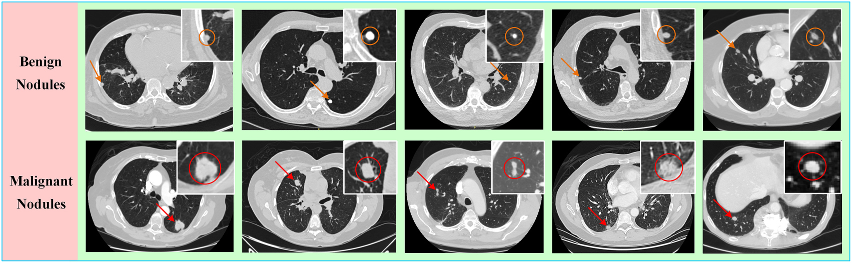 Classification of benign and malignant lung nodules from CT images ...