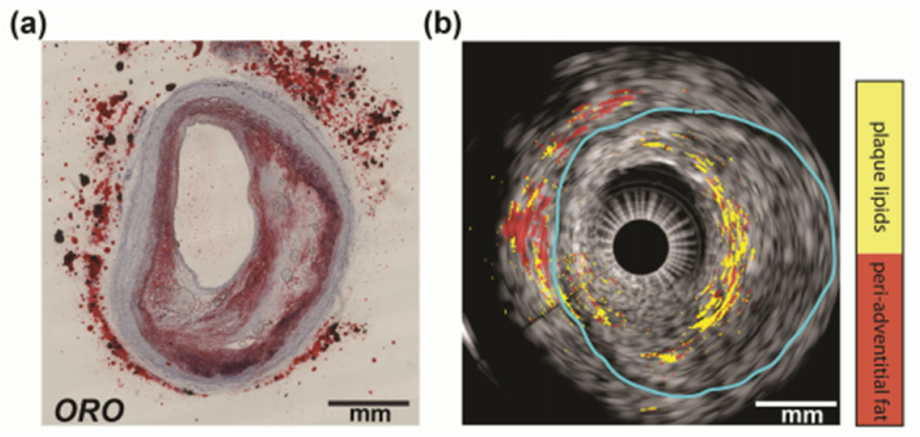 Photoacoustic imaging for guidance of interventions in cardiovascular ...