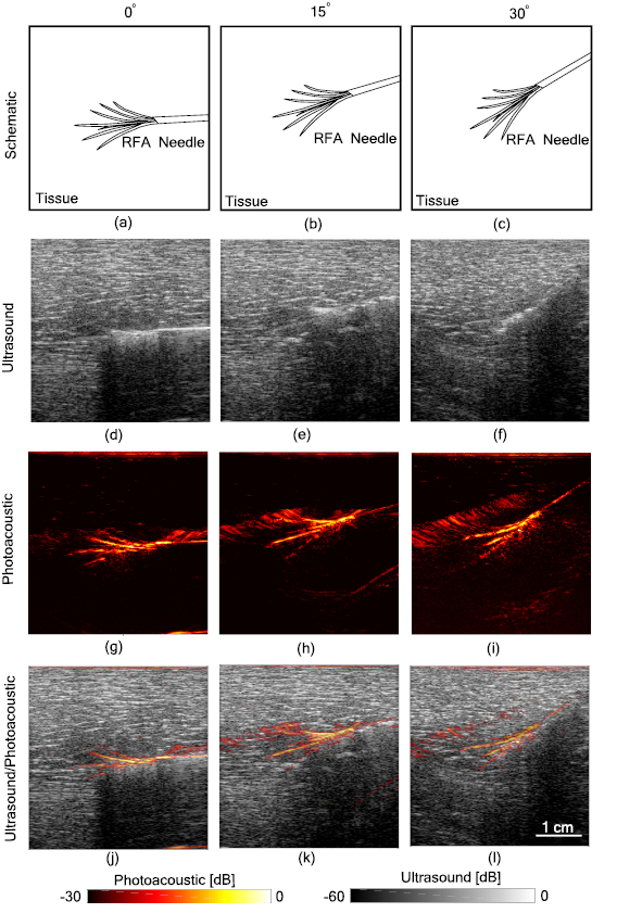 Photoacoustic imaging in percutaneous radiofrequency ablation: device ...