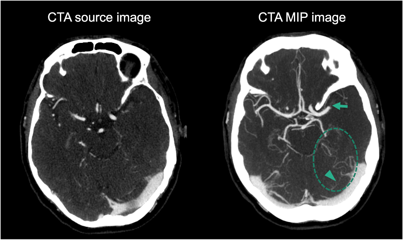 Ct Mini Mip Image Impacts of photon counting CT to maximum intensity projection (MIP ...