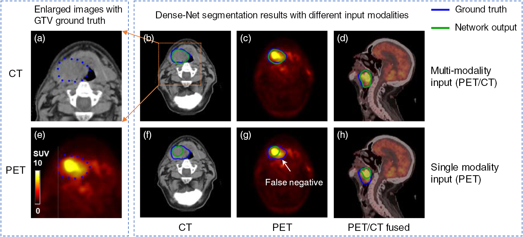 Gross tumor volume segmentation for head and neck cancer radiotherapy ...