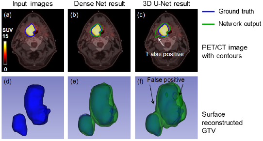 Gross tumor volume segmentation for head and neck cancer radiotherapy ...