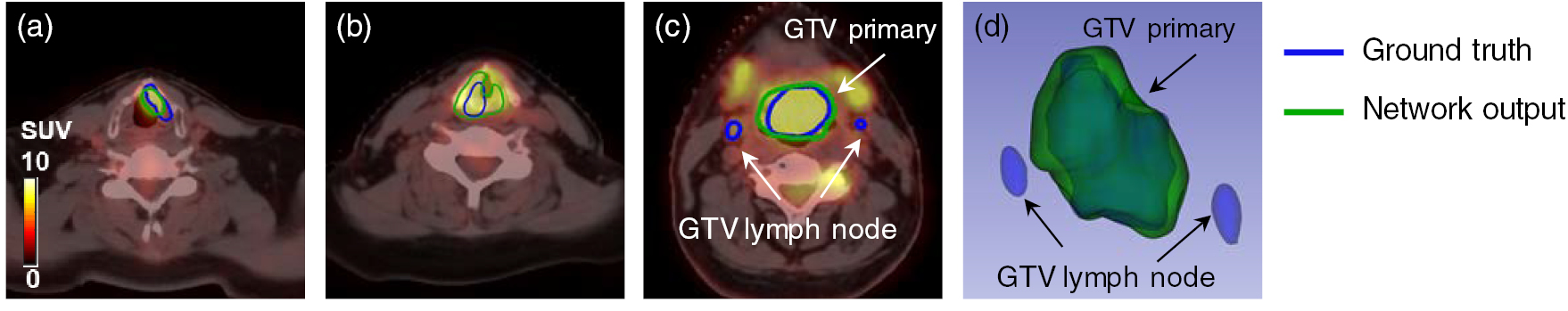 Gross tumor volume segmentation for head and neck cancer radiotherapy ...