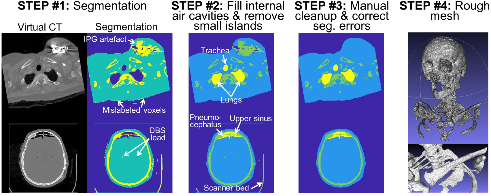 The ‘virtual DBS population’: five realistic computational models of ...