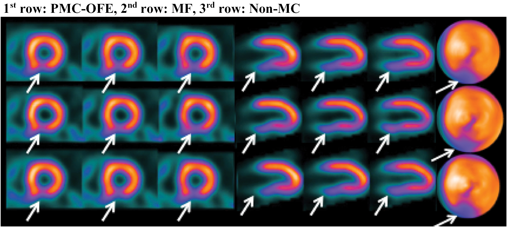 Cardiac motion correction for improving perfusion defect detection in ...