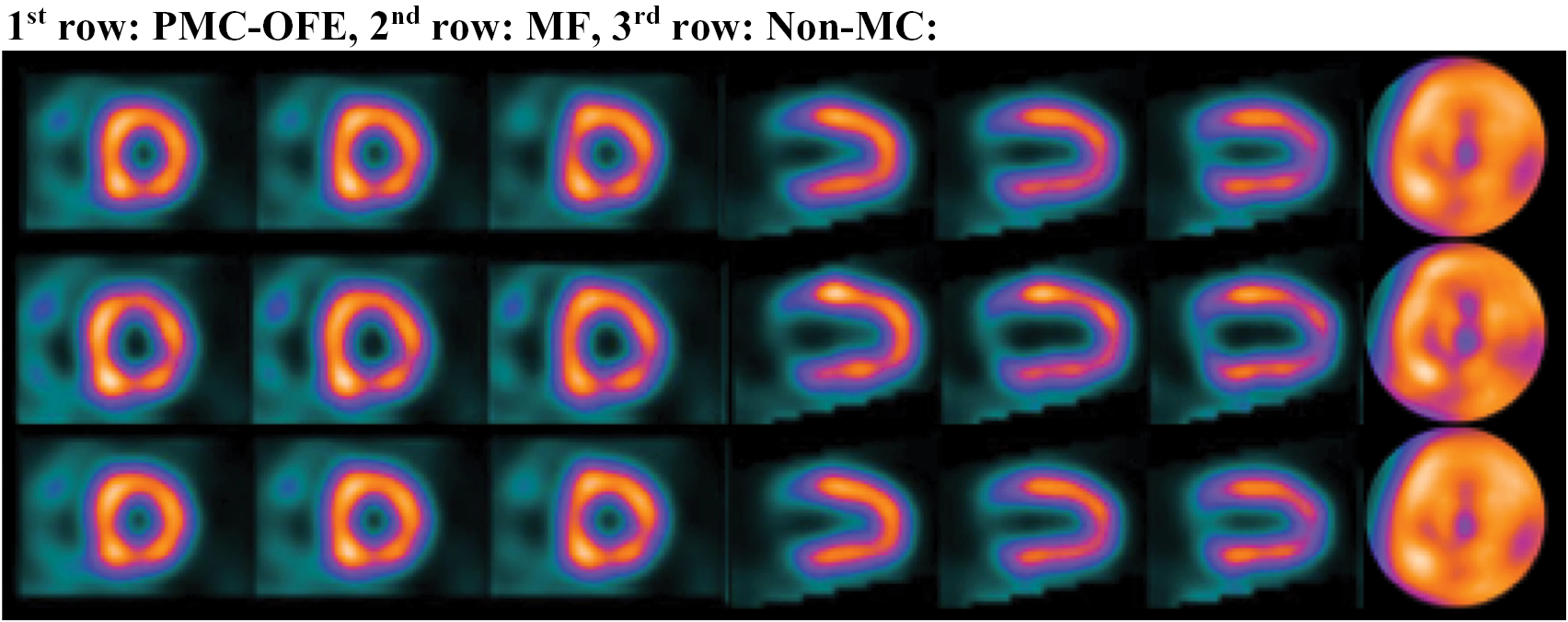 Cardiac motion correction for improving perfusion defect detection in ...