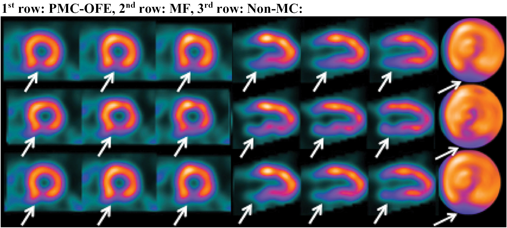 Cardiac motion correction for improving perfusion defect detection in ...