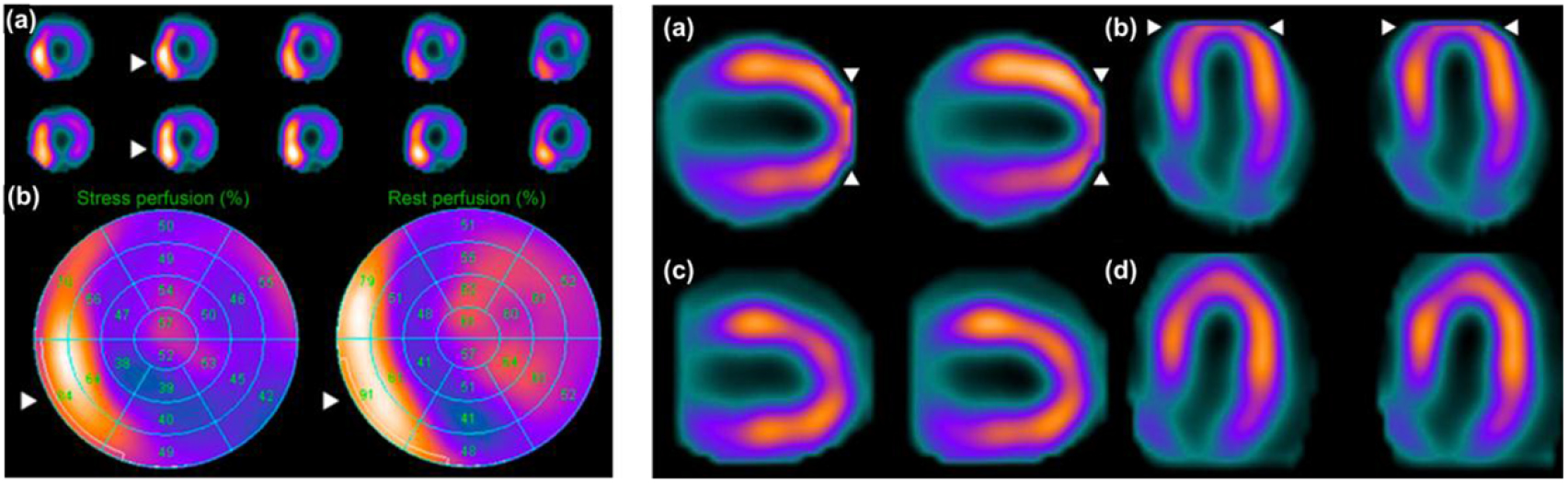 Recent advances in cardiac SPECT instrumentation and imaging methods ...