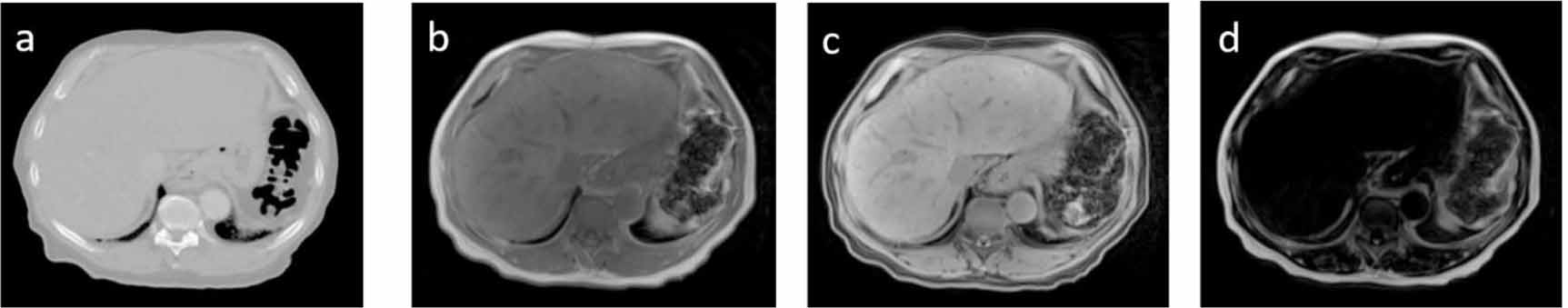 Abdominal synthetic CT generation from MR Dixon images using a U-net ...