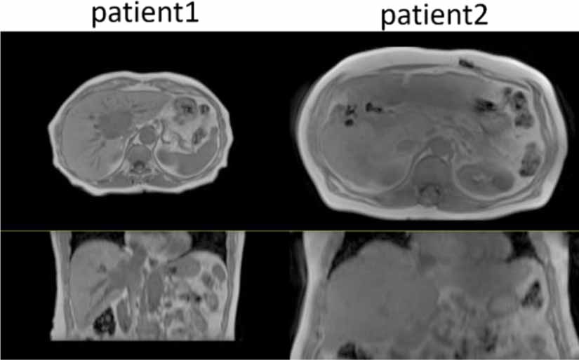 Abdominal synthetic CT generation from MR Dixon images using a U-net ...
