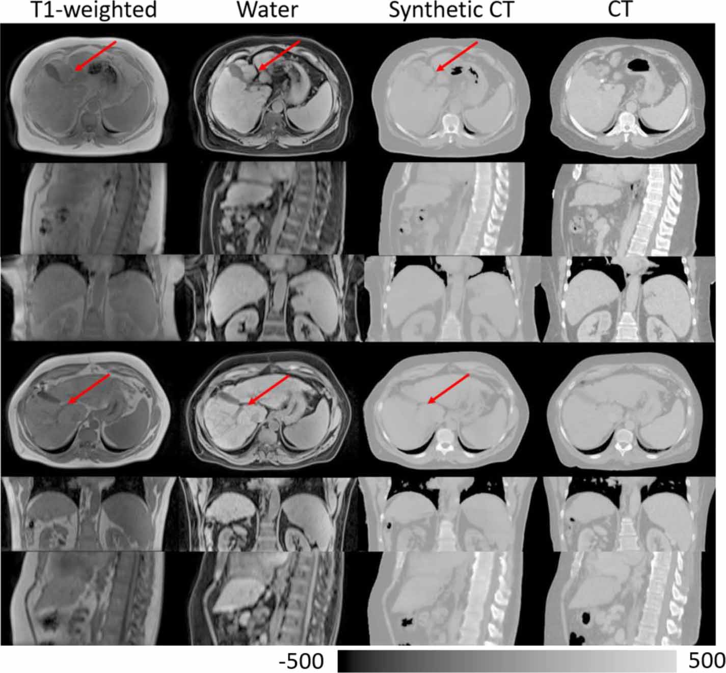 Abdominal synthetic CT generation from MR Dixon images using a U-net ...
