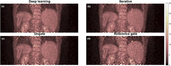 Motion correction of respiratory-gated PET images using deep learning ...