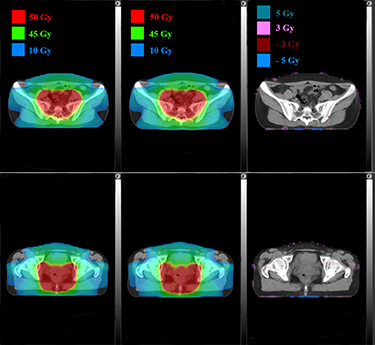 Data-driven dose calculation algorithm based on deep U-Net - IOPscience