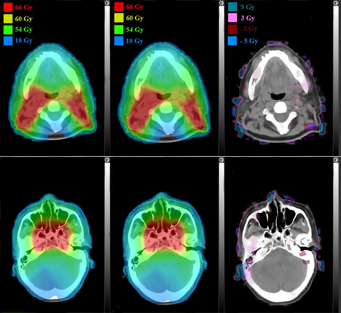 Data-driven dose calculation algorithm based on deep U-Net - IOPscience