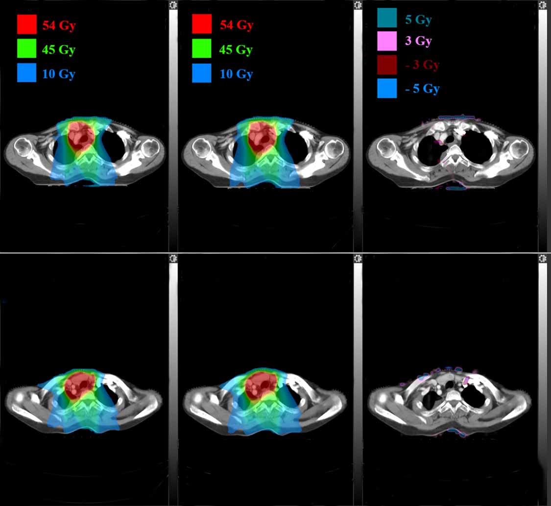 Data-driven dose calculation algorithm based on deep U-Net - IOPscience