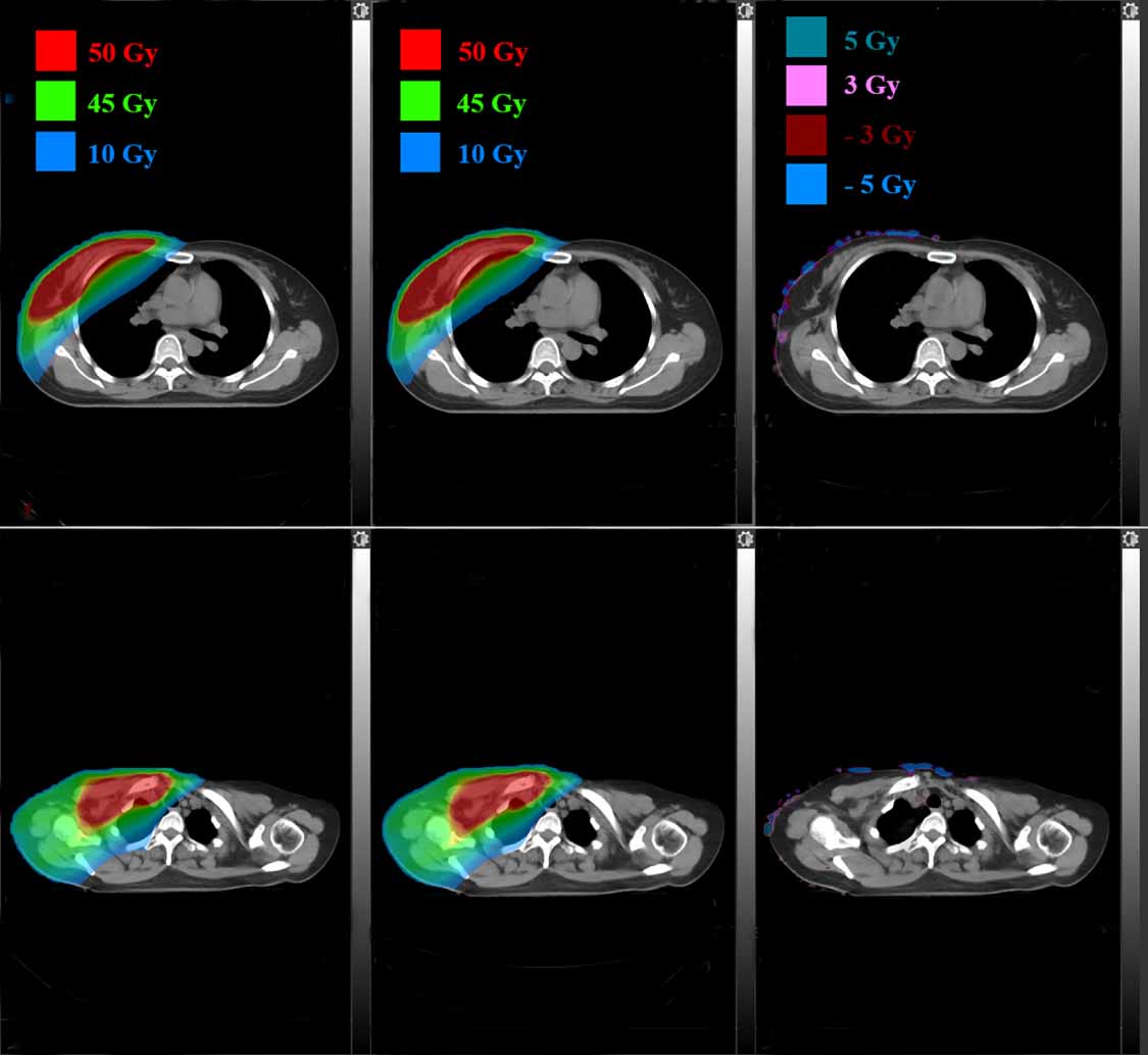 Data-driven dose calculation algorithm based on deep U-Net - IOPscience